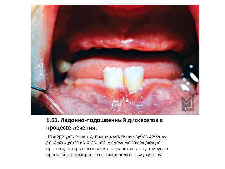 1. 61. Ладонно-подошвенный дискератоз в процессе лечения. По мере удалении подвижных молочных зубов ребенку
