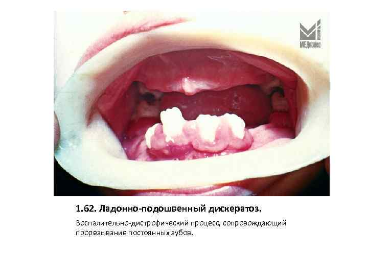 1. 62. Ладонно-подошвенный дискератоз. Воспалительно-дистрофический процесс, сопровождающий прорезывание постоянных зубов. 