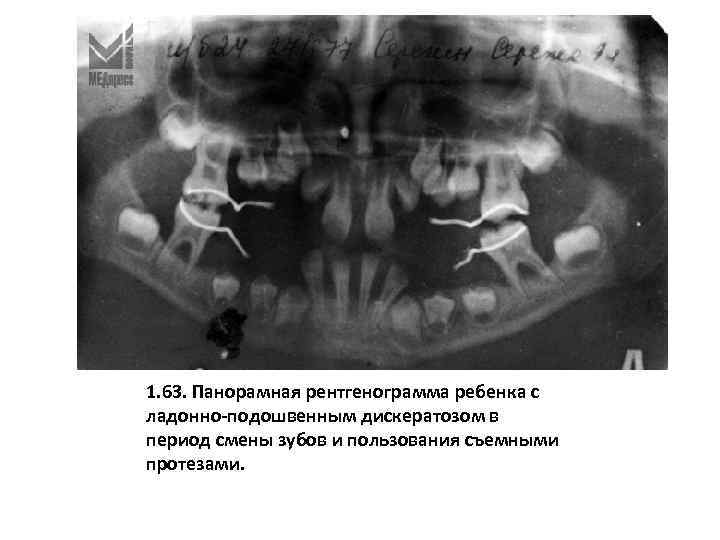 1. 63. Панорамная рентгенограмма ребенка с ладонно-подошвенным дискератозом в период смены зубов и пользования