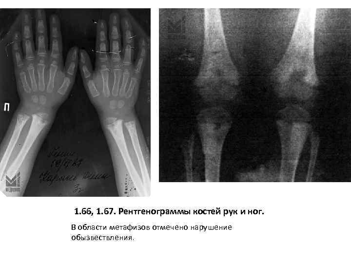 1. 66, 1. 67. Рентгенограммы костей рук и ног. В области метафизов отмечено нарушение