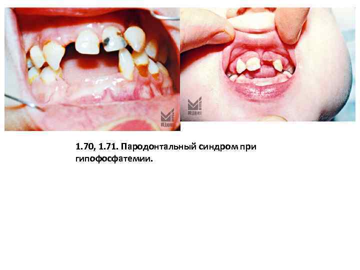 1. 70, 1. 71. Пародонтальный синдром при гипофосфатемии. 