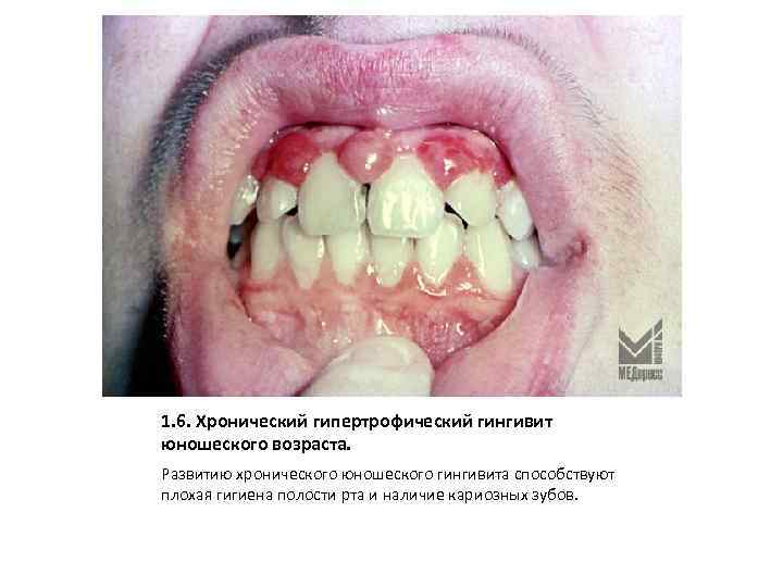 1. 6. Хронический гипертрофический гингивит юношеского возраста. Развитию хронического юношеского гингивита способствуют плохая гигиена