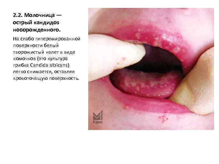 2. 2. Молочница — острый кандидоз новорожденного. На слабо гиперемированной поверхности белый творожистый налет