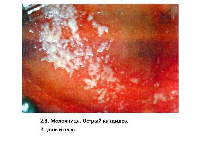 2. 3. Молочница. Острый кандидоз. Крупный план. 