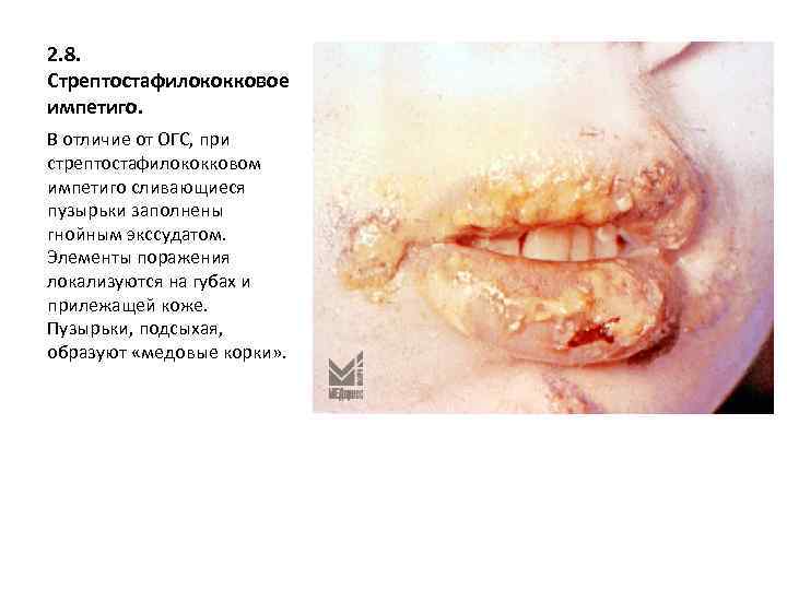 2. 8. Стрептостафилококковое импетиго. В отличие от ОГС, при стрептостафилококковом импетиго сливающиеся пузырьки заполнены