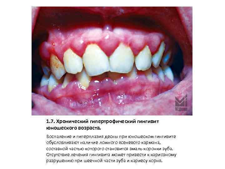 1. 7. Хронический гипертрофический гингивит юношеского возраста. Воспаление и гиперплазия десны при юношеском гингивите