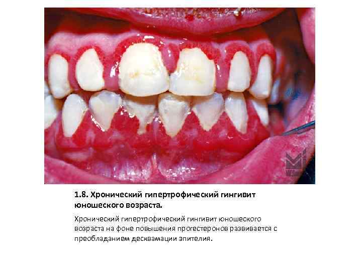 1. 8. Хронический гипертрофический гингивит юношеского возраста на фоне повышения прогестеронов развивается с преобладанием