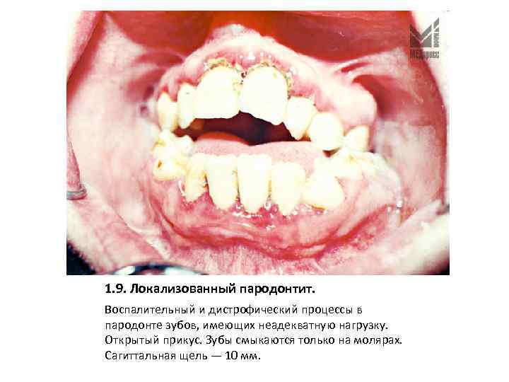 1. 9. Локализованный пародонтит. Воспалительный и дистрофический процессы в пародонте зубов, имеющих неадекватную нагрузку.