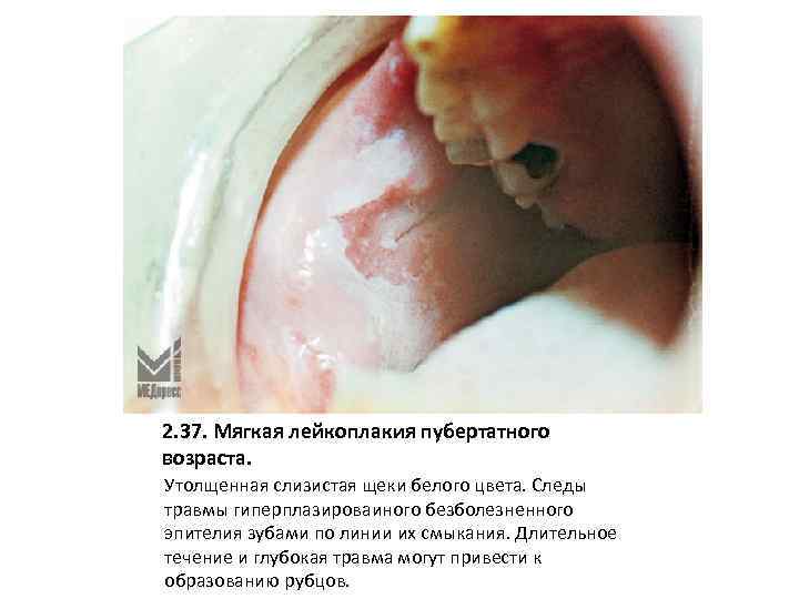 2. 37. Мягкая лейкоплакия пубертатного возраста. Утолщенная слизистая щеки белого цвета. Следы травмы гиперплазироваиного