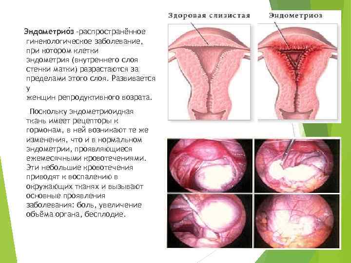 Эндометрио з -распространённое гинекологическое заболевание, при котором клетки эндометрия (внутреннего слоя стенки матки) разрастаются