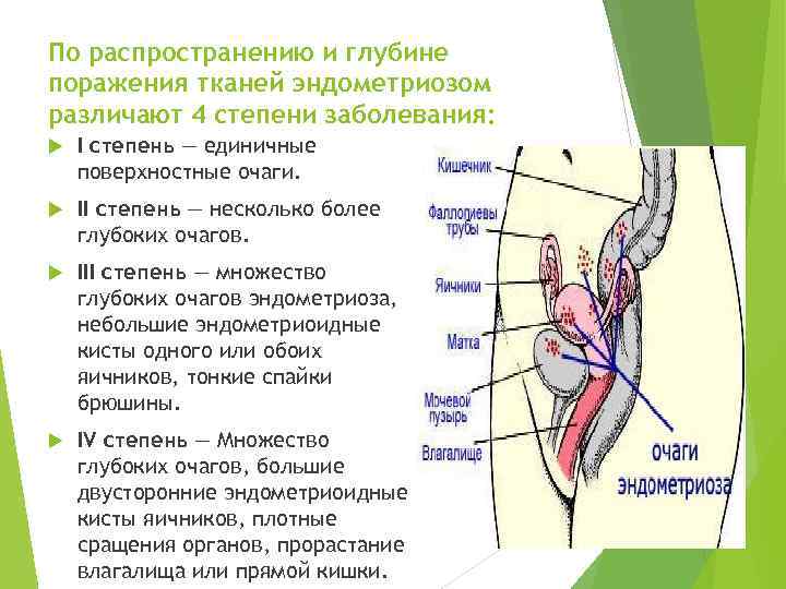 По распространению и глубине поражения тканей эндометриозом различают 4 степени заболевания: I степень —