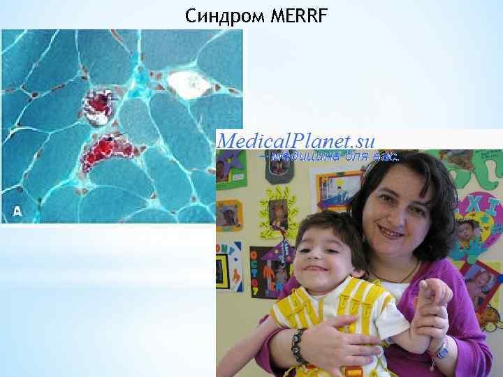 Синдром MERRF 