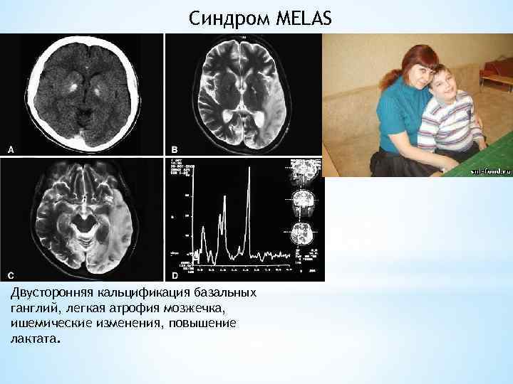 Синдром мелас презентация