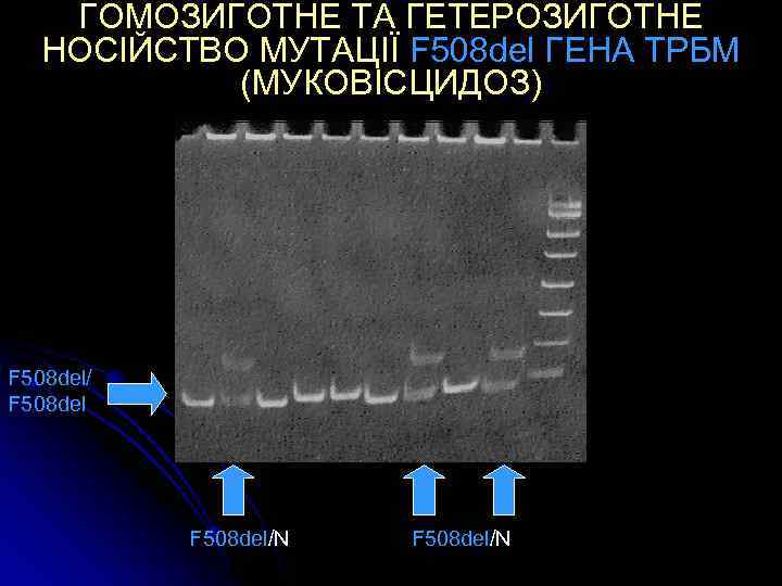ГОМОЗИГОТНЕ ТА ГЕТЕРОЗИГОТНЕ НОСІЙСТВО МУТАЦІЇ F 508 del ГЕНА ТРБМ (МУКОВІСЦИДОЗ) F 508 del/N