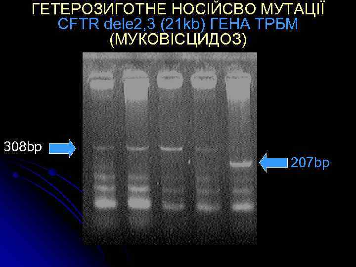 ГЕТЕРОЗИГОТНЕ НОСІЙСВО МУТАЦІЇ CFTR dele 2, 3 (21 kb) ГЕНА ТРБМ (МУКОВІСЦИДОЗ) 308 bp