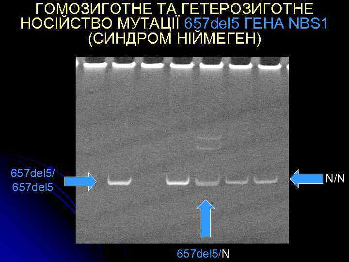 ГОМОЗИГОТНЕ ТА ГЕТЕРОЗИГОТНЕ НОСІЙСТВО МУТАЦІЇ 657 del 5 ГЕНА NBS 1 (СИНДРОМ НІЙМЕГЕН) 657