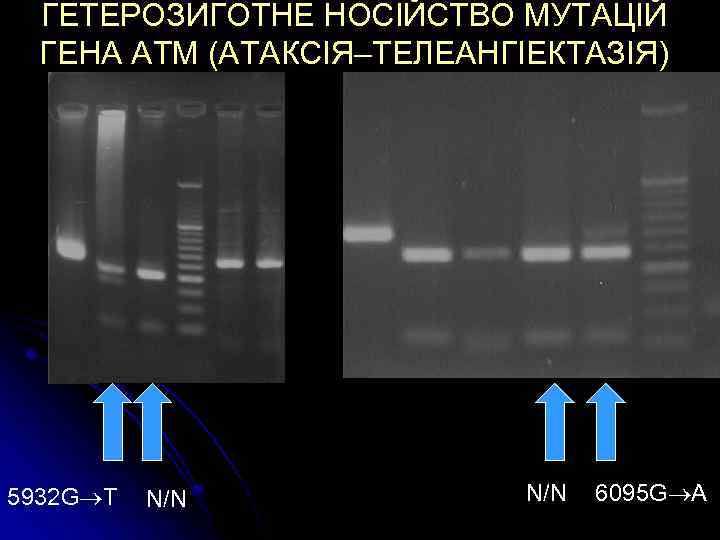 ГЕТЕРОЗИГОТНЕ НОСІЙСТВО МУТАЦІЙ ГЕНА АТМ (АТАКСІЯ–ТЕЛЕАНГІЕКТАЗІЯ) 5932 G T N/N 6095 G A 