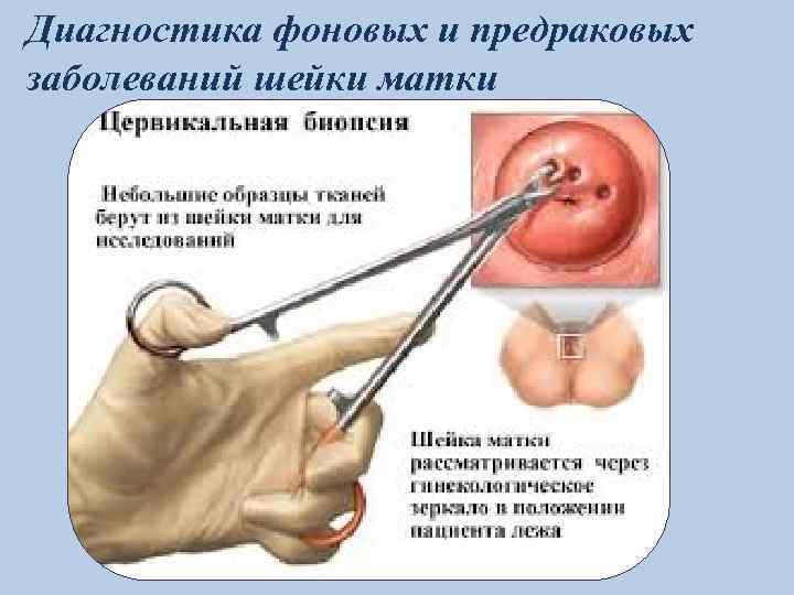 Диагностика фоновых и предраковых заболеваний шейки матки 