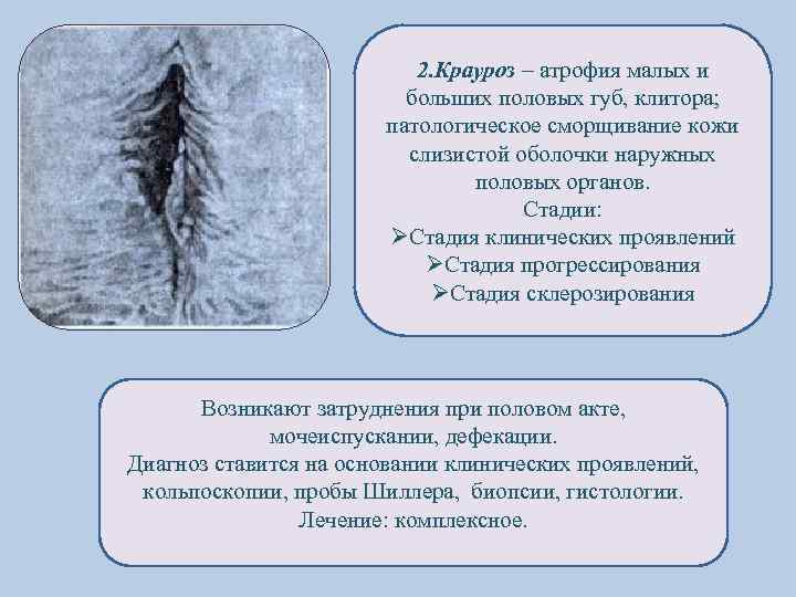 2. Крауроз – атрофия малых и больших половых губ, клитора; патологическое сморщивание кожи слизистой