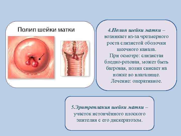 4. Полип шейки матки – возникает из-за чрезмерного роста слизистой оболочки шеечного канала. При