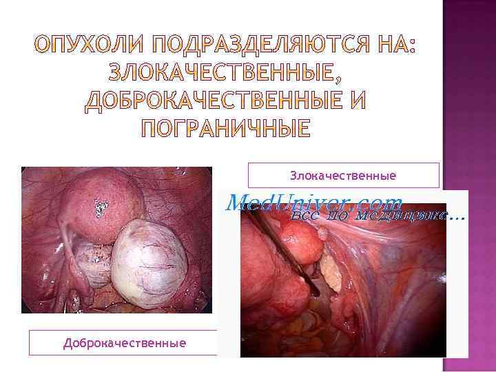 Злокачественные Доброкачественные 