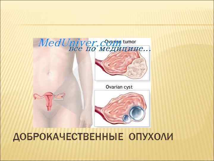 ДОБРОКАЧЕСТВЕННЫЕ ОПУХОЛИ 