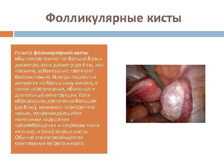 Фолликулярные кисты Размер фолликулярной кисты обычно составляет не больше 8 см в диаметре, если