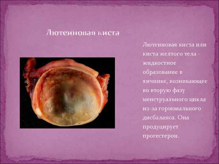 Лютеиновая киста или киста желтого тела жидкостное образование в яичнике, возникающее во вторую фазу