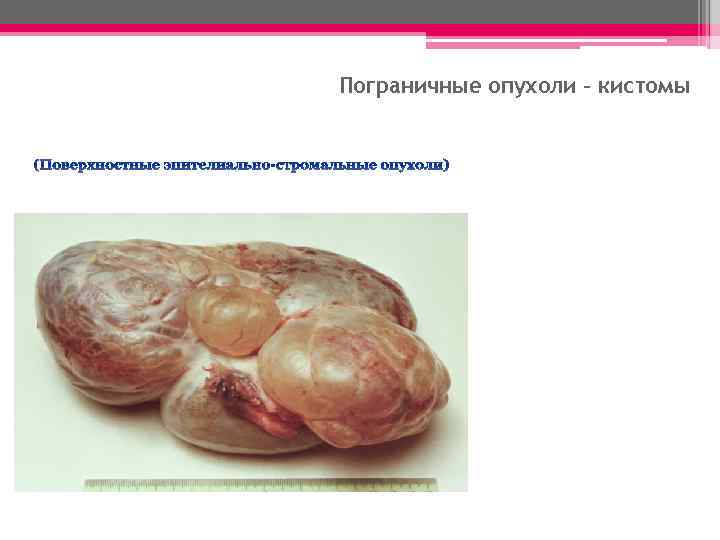 Пограничные опухоли – кистомы (Поверхностные эпителиально-стромальные опухоли) 