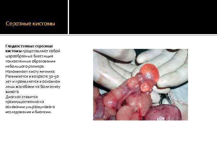 Серозные кистомы Гладкостенные серозные кистомы представляют собой шарообразные блестящие тонкостенные образования небольшого размера. Напоминает