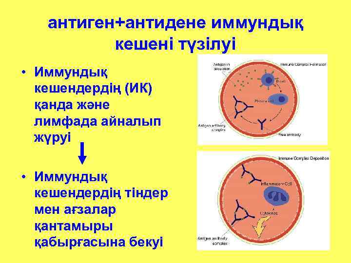 антиген+антидене иммундық кешені түзілуі • Иммундық кешендердің (ИК) қанда және лимфада айналып жүруі •