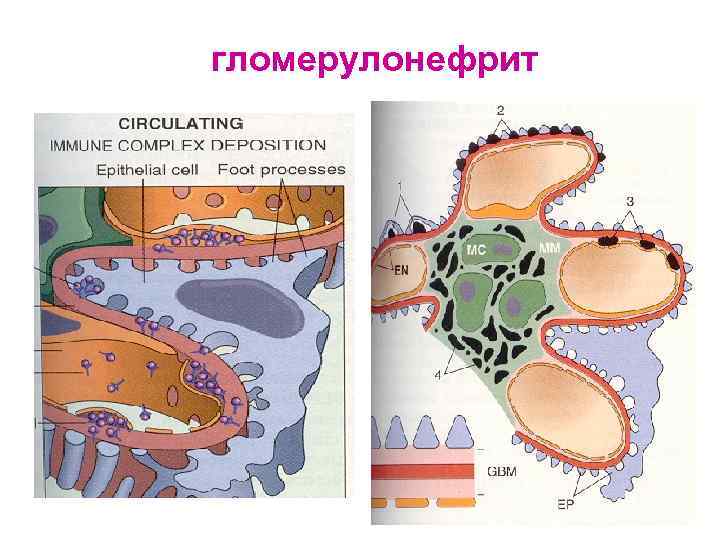 гломерулонефрит 