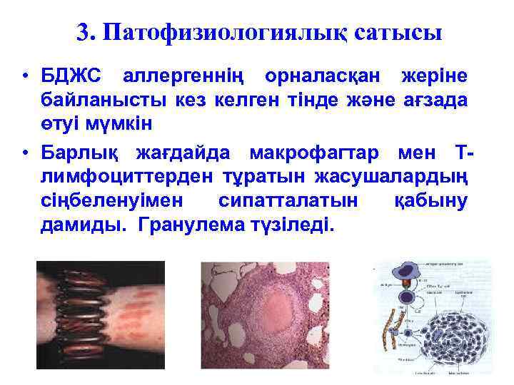 3. Патофизиологиялық сатысы • БДЖС аллергеннің орналасқан жеріне байланысты кез келген тінде және ағзада