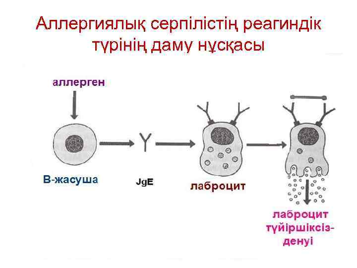 Аллергиялық серпілістің реагиндік түрінің даму нұсқасы 