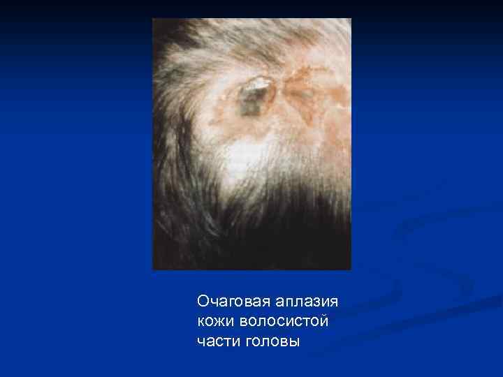 Очаговая аплазия кожи волосистой части головы 