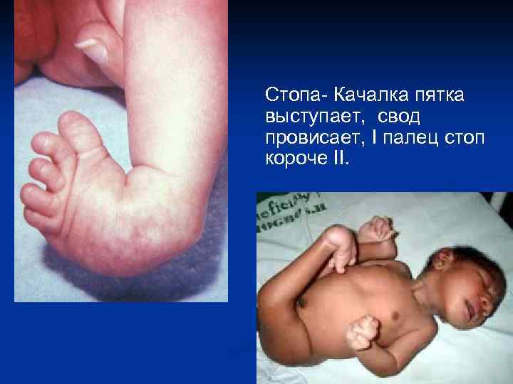 Стопа- Качалка пятка выступает, свод провисает, I палец стоп короче II. 