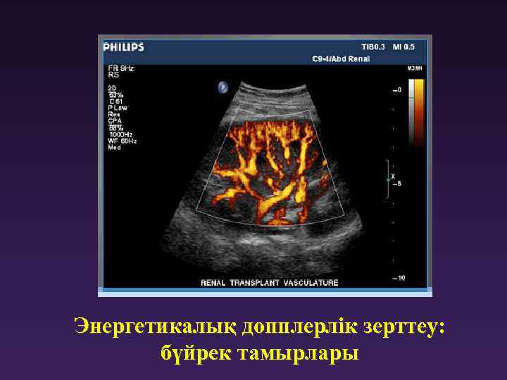 Энергетикалық допплерлік зерттеу: бүйрек тамырлары 