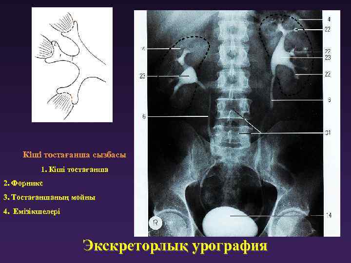 Экскреторная урография презентация