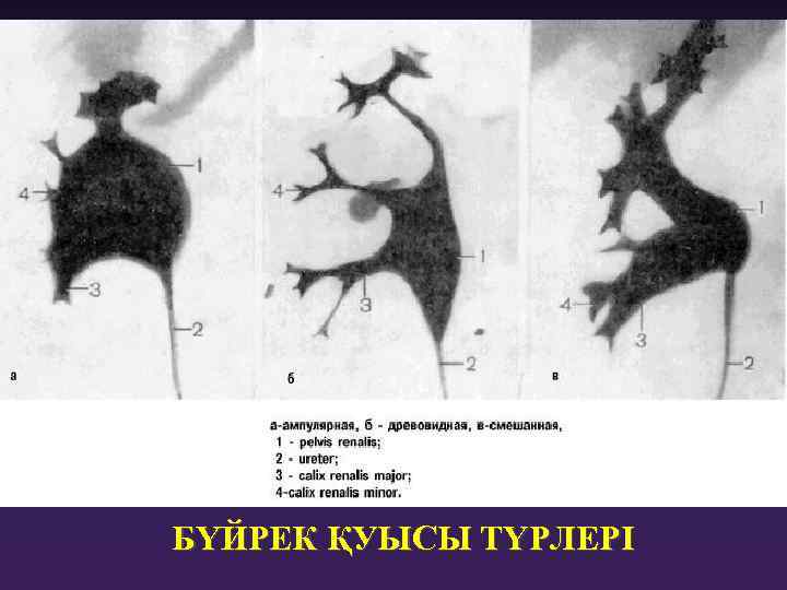 БҮЙРЕК ҚУЫСЫ ТҮРЛЕРІ 