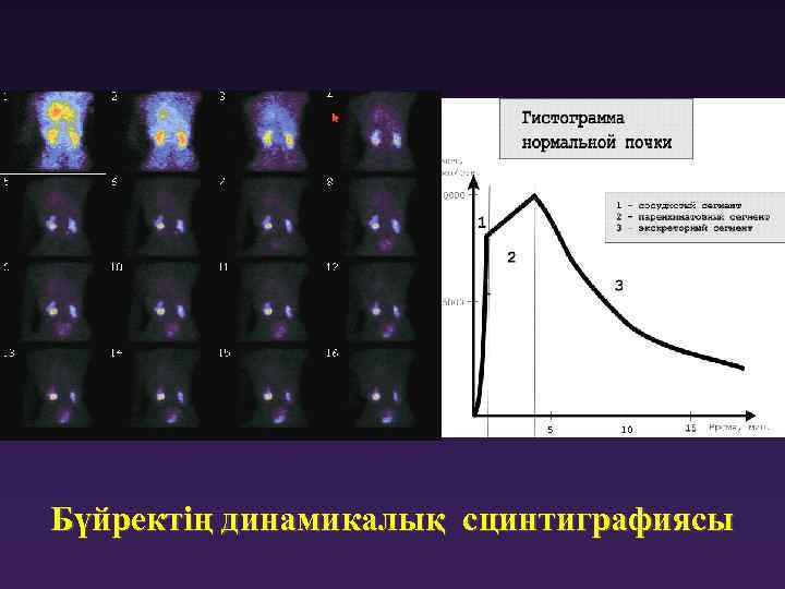Бүйректің динамикалық сцинтиграфиясы 