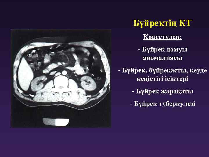 Бүйректің КТ Көрсетулер: - Бүйрек дамуы аномалиясы - Бүйрек, бүйрекасты, кеуде кеңістігі ісіктері -
