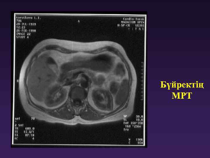 Бүйректің МРТ 