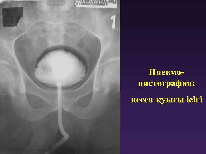 Пневмоцистография: несеп қуығы ісігі 