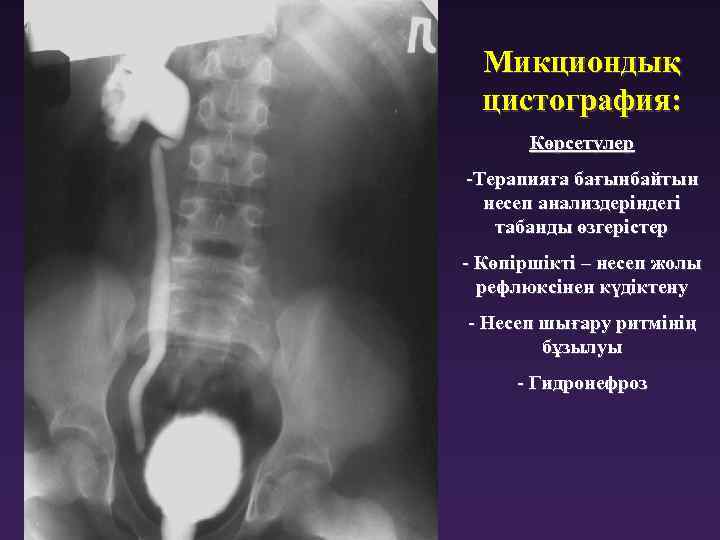 Микциондық цистография: Көрсетулер -Терапияға бағынбайтын несеп анализдеріндегі табанды өзгерістер - Көпіршікті – несеп жолы