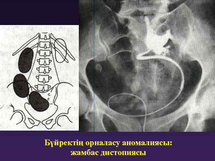 Бүйректің орналасу аномалиясы: жамбас дистопиясы 