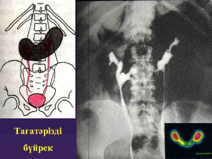Тағатәрізді бүйрек 