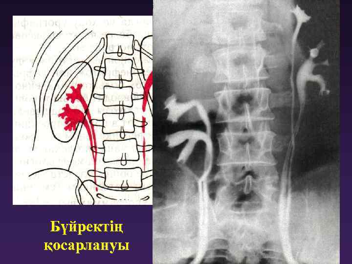 Бүйректің қосарлануы 