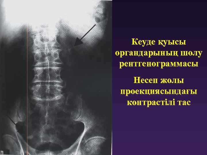 Кеуде қуысы органдарының шолу рентгенограммасы Несеп жолы проекциясындағы контрастілі тас 