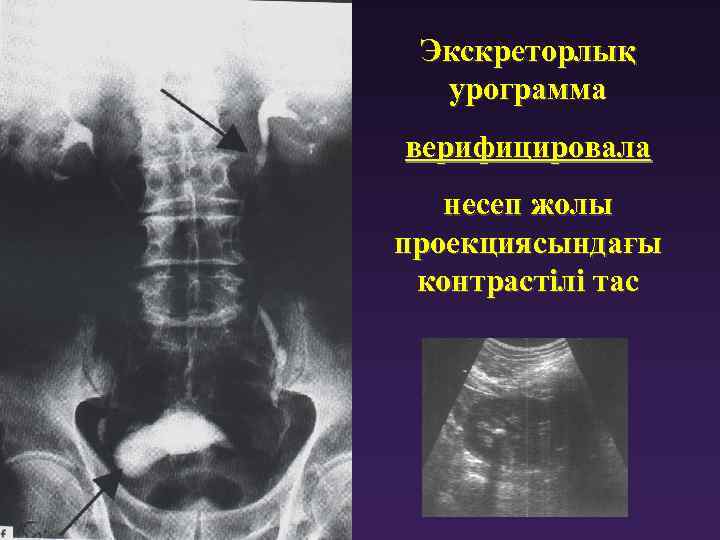 Экскреторлық урограмма верифицировала несеп жолы проекциясындағы контрастілі тас 