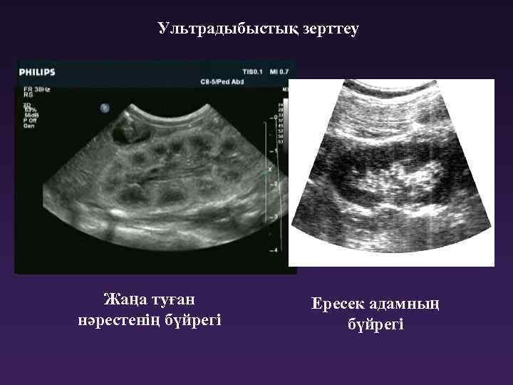 Взрослый почка узи. Анатомия почки на УЗИ почек. Топографическая анатомия почек УЗИ. Строение почки на УЗИ. УЗИ почек новорожденного.